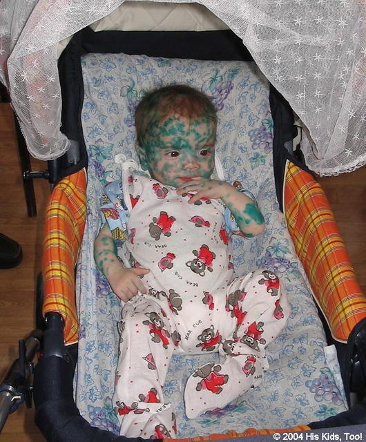 This entire facility had a chicken pox outbreak.  This little child is still recovering.  This green stuff is medicine.