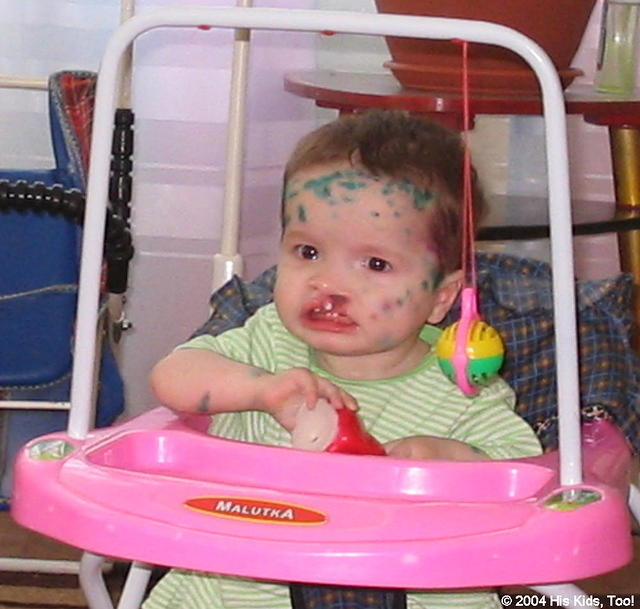 This little girl has a serious cleft palette, but it is surgically correctable.  (Update) this child has been adopted