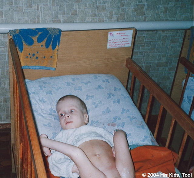 This child with spina bfida, chattered up a storm.  He is in desperate need of medical attention.