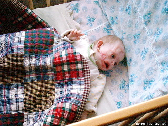 This little boy, was severely burned in an orphan facility at just 3 months old.  He will start having surgeries soon to help co