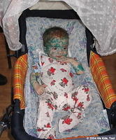This entire facility had a chicken pox outbreak.  This little child is still recovering.  This green stuff is medicine.
