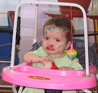 This little girl has a serious cleft palette, but it is surgically correctable.  (Update) this child has been adopted