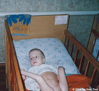 This child with spina bfida, chattered up a storm.  He is in desperate need of medical attention.